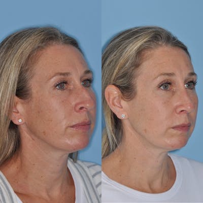 Rhinoplasty Before & After Gallery - Patient 31710079 - Image 1