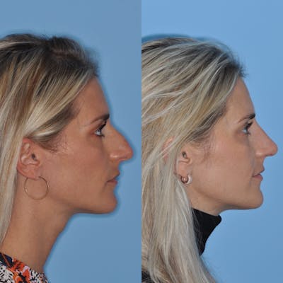 Rhinoplasty Before & After Gallery - Patient 31710078 - Image 2