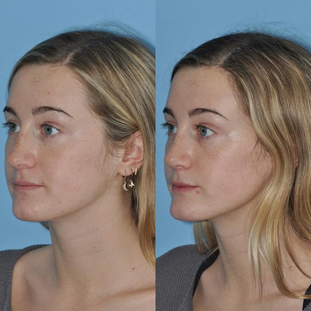 Rhinoplasty Before & After Gallery - Patient 31710077 - Image 3