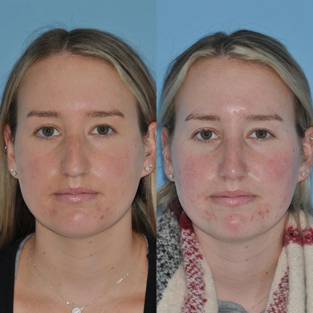 Rhinoplasty Before & After Gallery - Patient 31710076 - Image 4