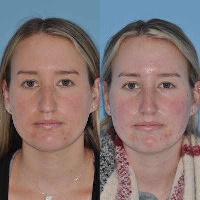 Rhinoplasty Before & After Gallery - Patient 31710076 - Image 4