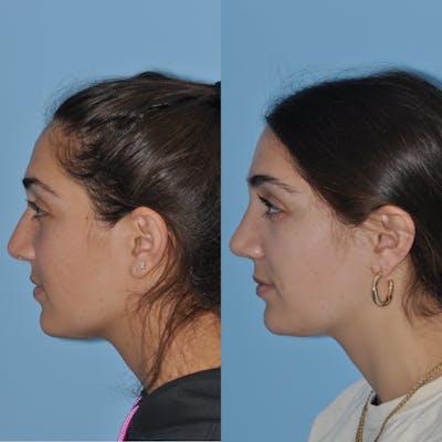 Rhinoplasty Before & After Gallery - Patient 31710075 - Image 6