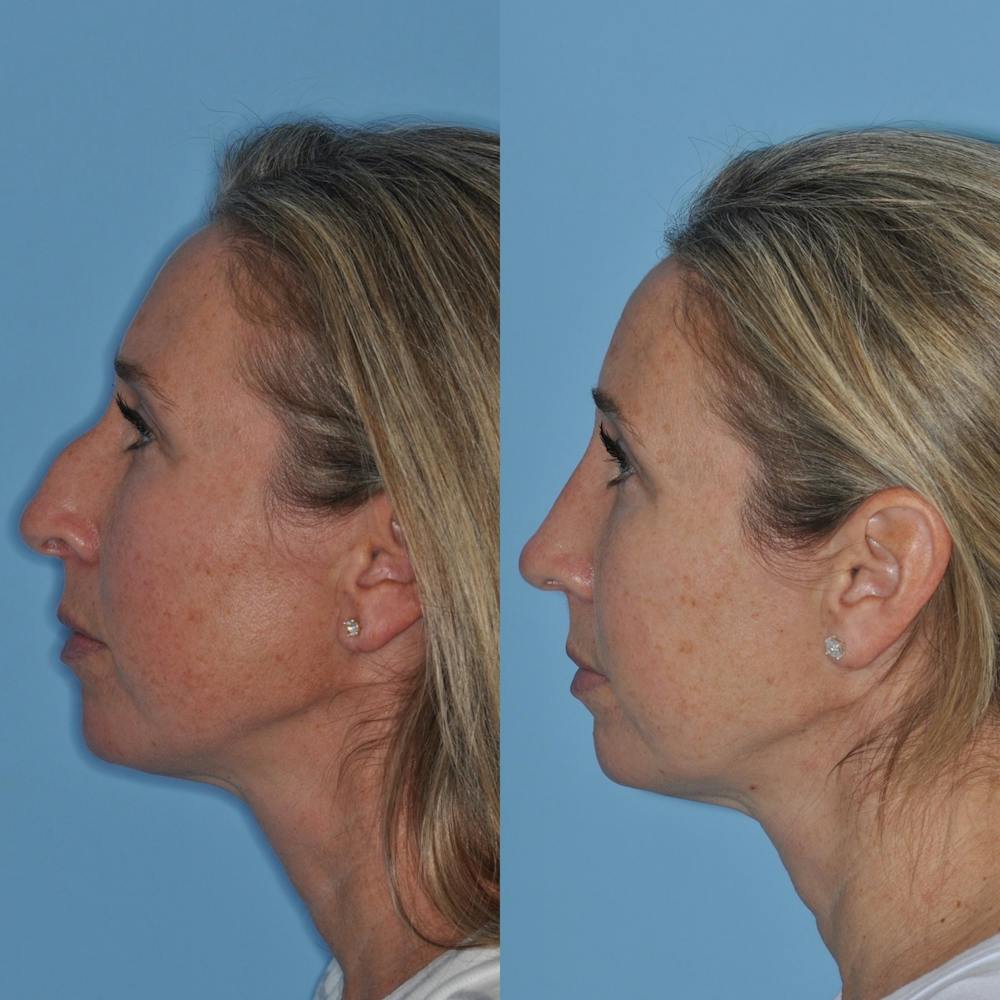 Rhinoplasty Before & After Gallery - Patient 31710079 - Image 2
