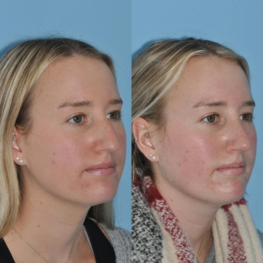 Rhinoplasty Before & After Gallery - Patient 31710076 - Image 5