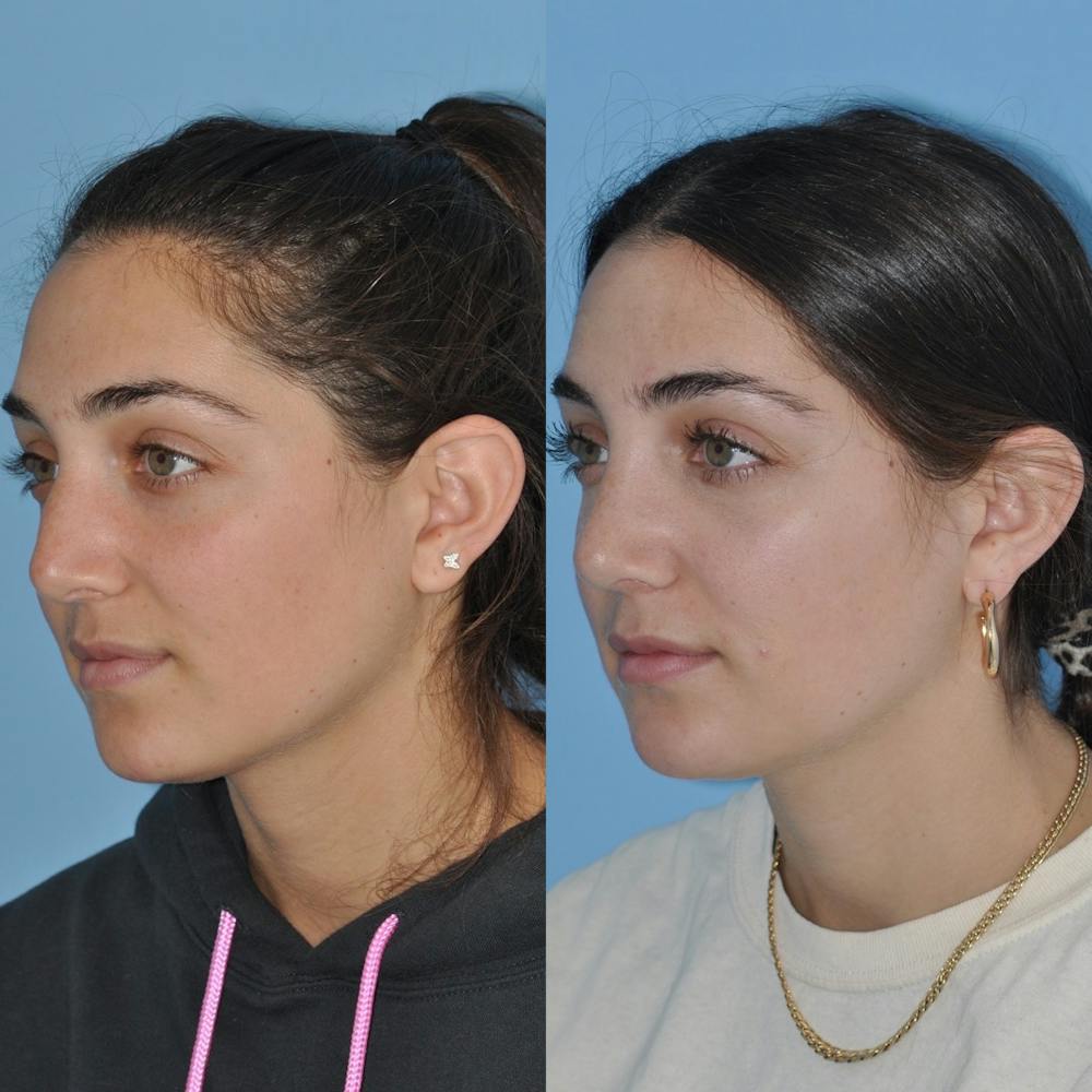 Rhinoplasty Before & After Gallery - Patient 31710075 - Image 7