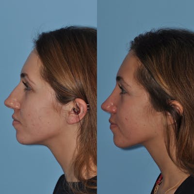 Rhinoplasty Before & After Gallery - Patient 31710081 - Image 1