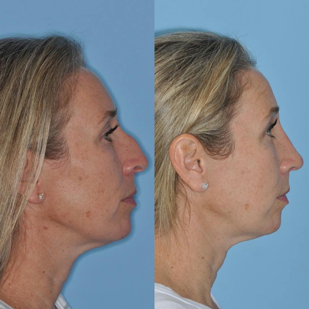 Rhinoplasty Before & After Gallery - Patient 31710079 - Image 3