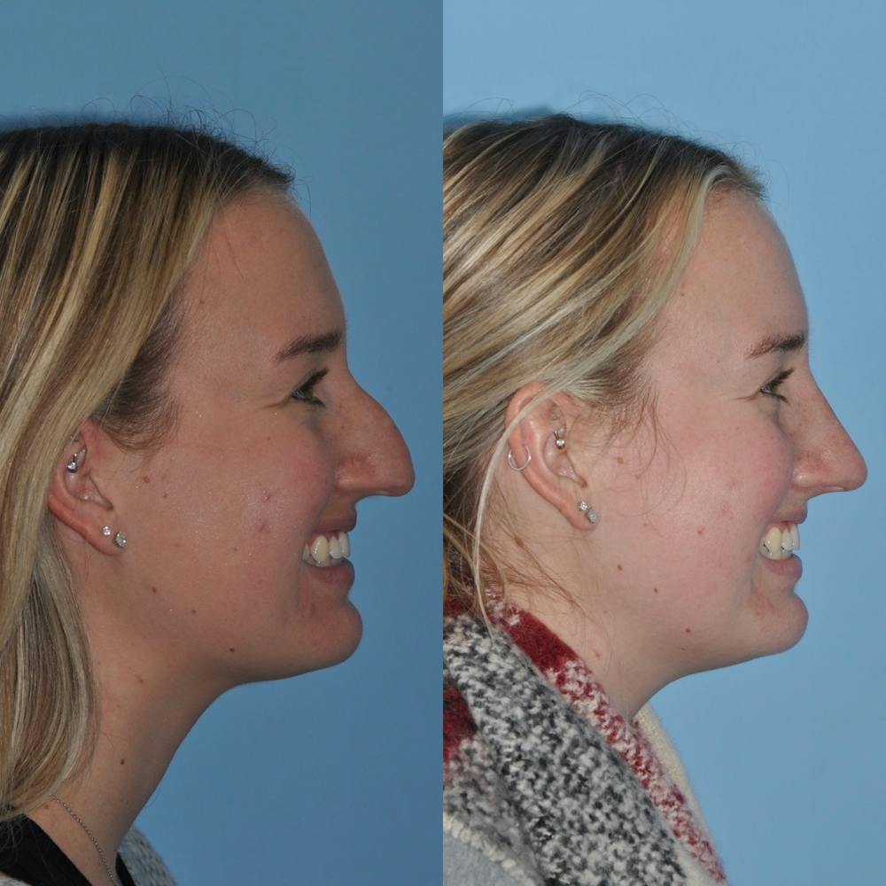 Rhinoplasty Before & After Gallery - Patient 31710076 - Image 6