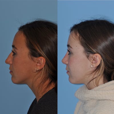 Rhinoplasty Before & After Gallery - Patient 31710082 - Image 1