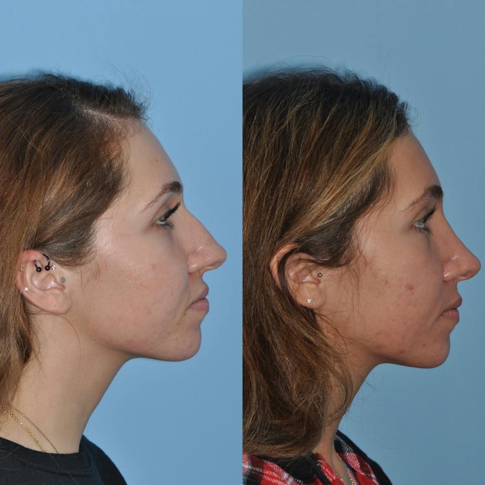 Rhinoplasty Before & After Gallery - Patient 31710081 - Image 2