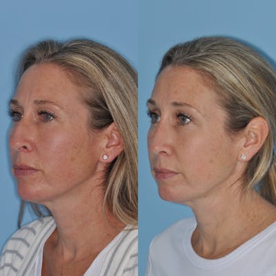 Rhinoplasty Before & After Gallery - Patient 31710079 - Image 4