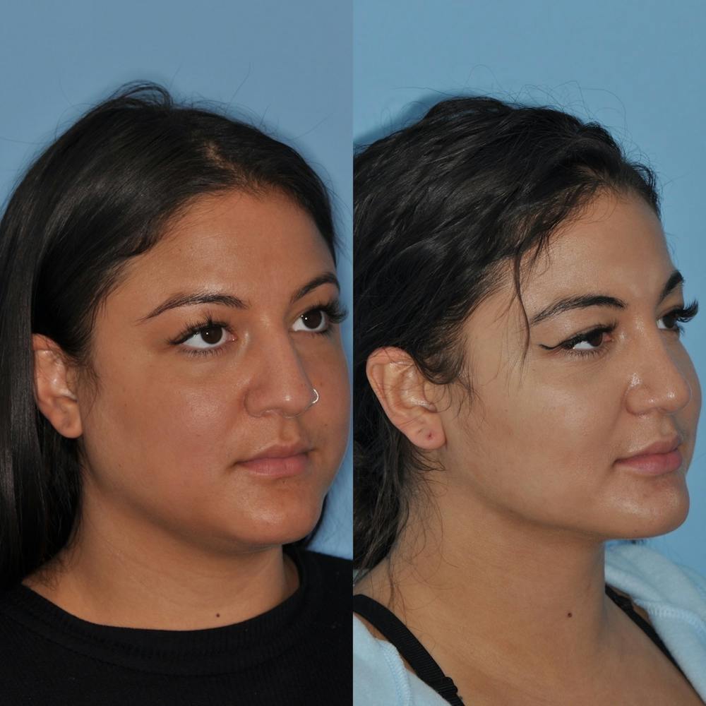 Rhinoplasty Before & After Gallery - Patient 31710080 - Image 3