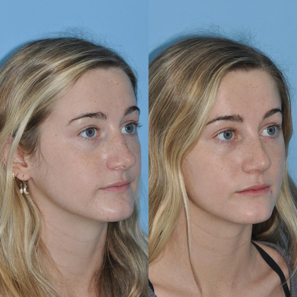 Rhinoplasty Before & After Gallery - Patient 31710077 - Image 5
