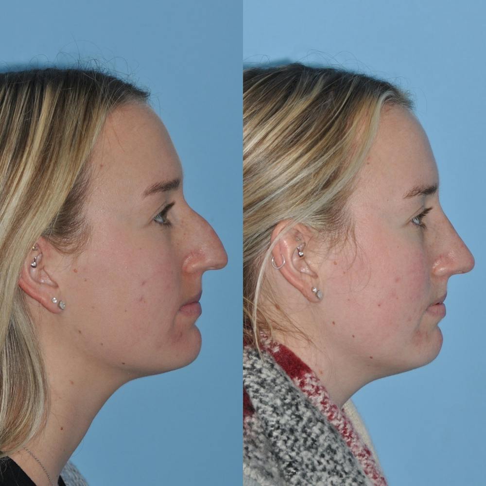 Rhinoplasty Before & After Gallery - Patient 31710076 - Image 7