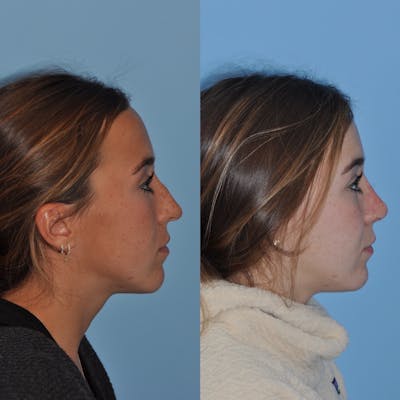 Rhinoplasty Before & After Gallery - Patient 31710082 - Image 2