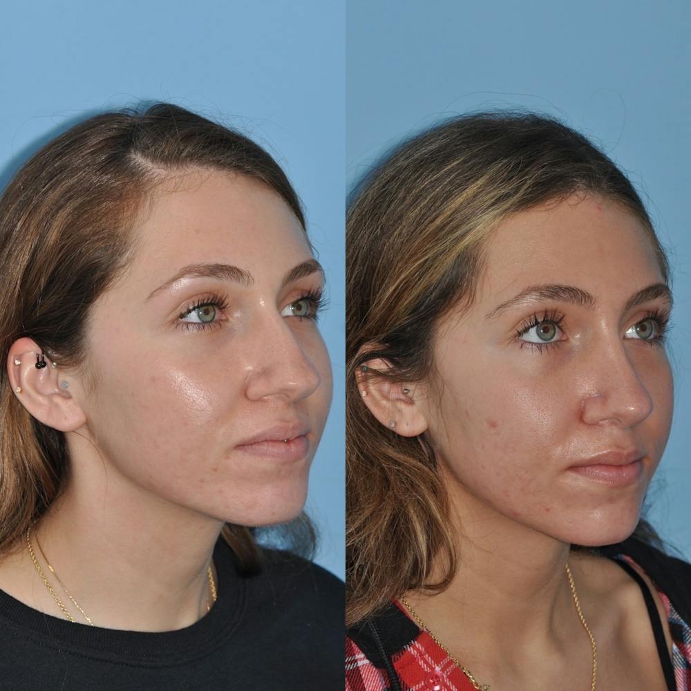 Rhinoplasty Before & After Gallery - Patient 31710081 - Image 3