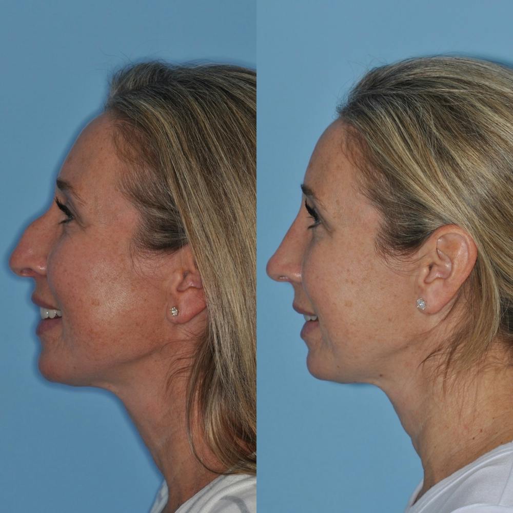 Rhinoplasty Before & After Gallery - Patient 31710079 - Image 5