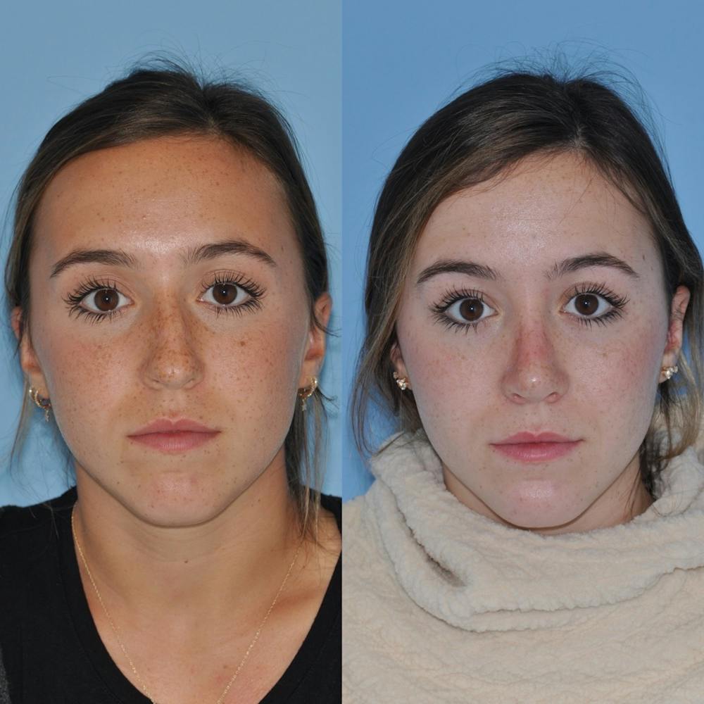 Rhinoplasty Before & After Gallery - Patient 31710082 - Image 3