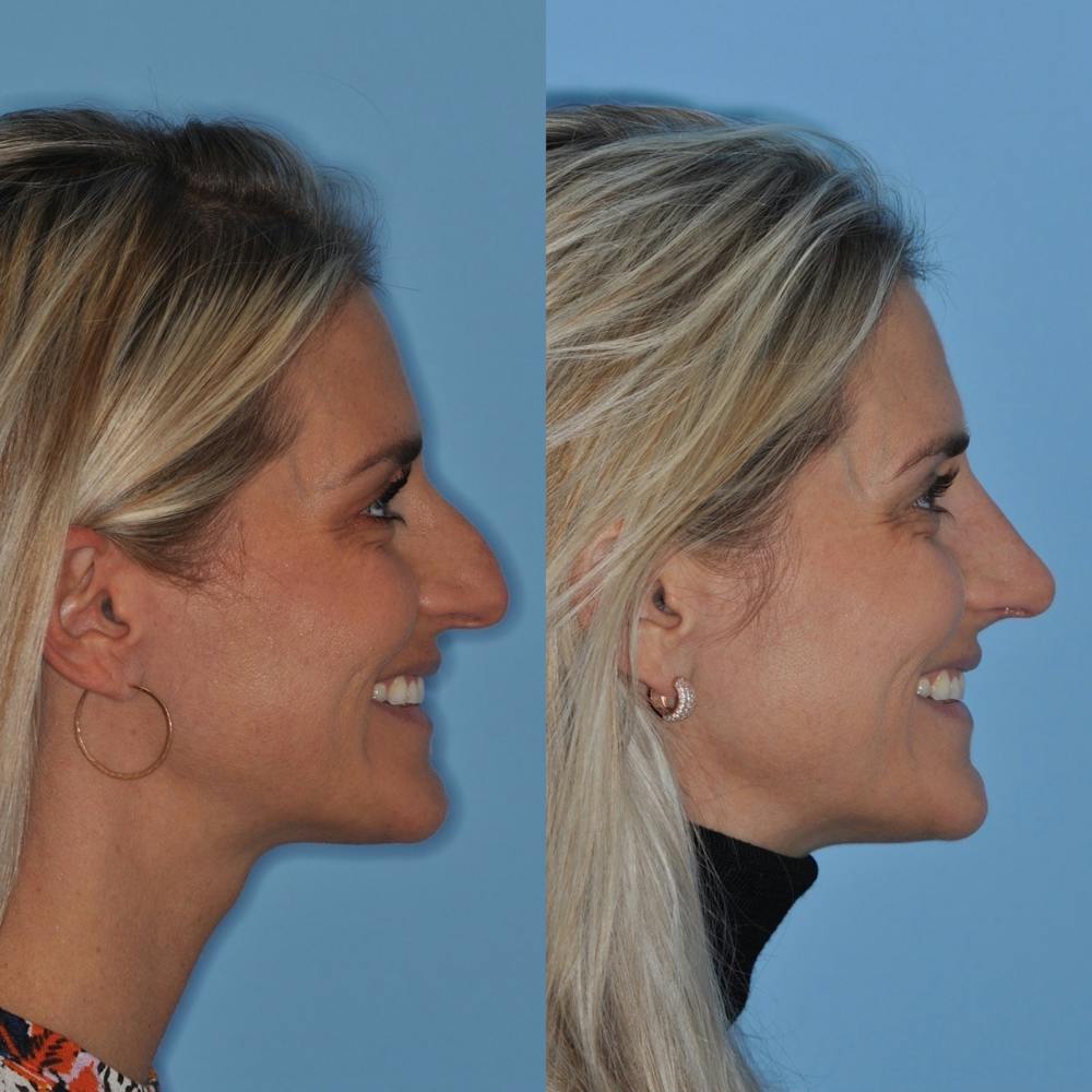 Rhinoplasty Before & After Gallery - Patient 31710078 - Image 6