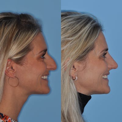 Rhinoplasty Before & After Gallery - Patient 31710078 - Image 6