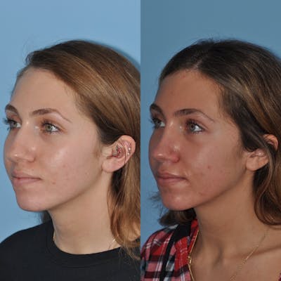Rhinoplasty Before & After Gallery - Patient 31710081 - Image 4