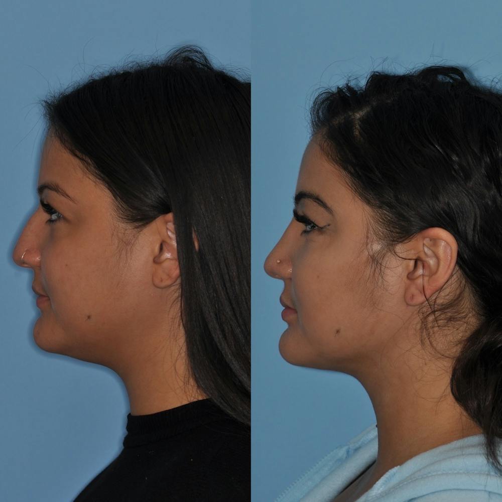 Rhinoplasty Before & After Gallery - Patient 31710080 - Image 5