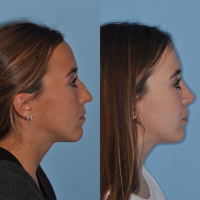 Rhinoplasty Before & After Gallery - Patient 31710082 - Image 4