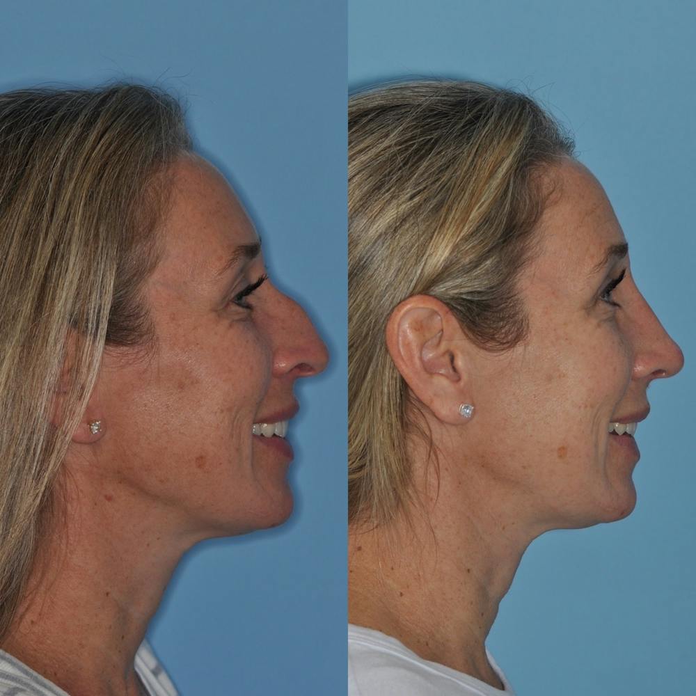 Rhinoplasty Before & After Gallery - Patient 31710079 - Image 7