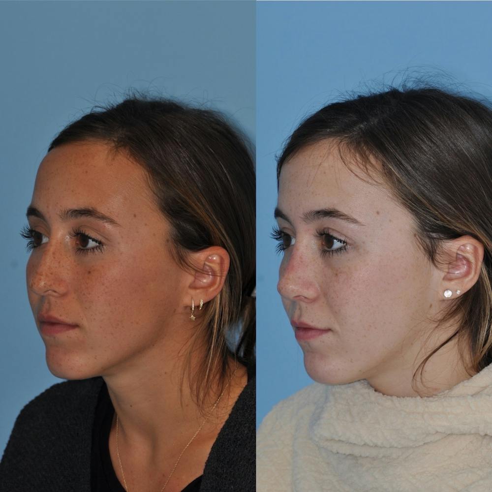 Rhinoplasty Before & After Gallery - Patient 31710082 - Image 5