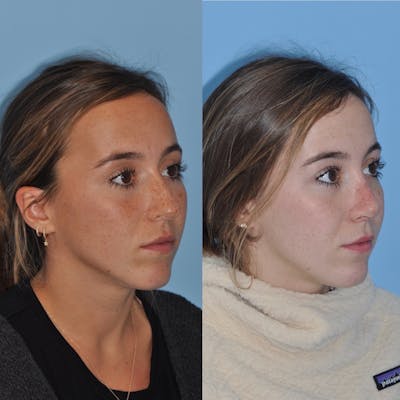 Rhinoplasty Before & After Gallery - Patient 31710082 - Image 6