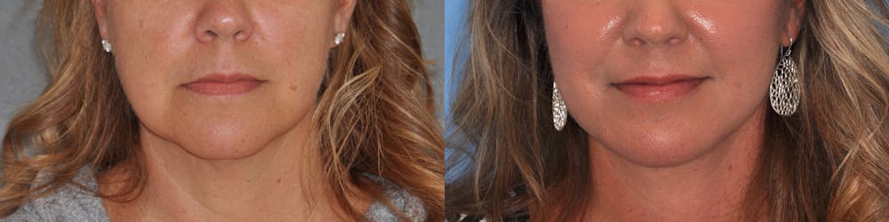 Facelift Before & After Gallery - Patient 31709460 - Image 1