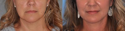 Facelift Before & After Gallery - Patient 31709460 - Image 1