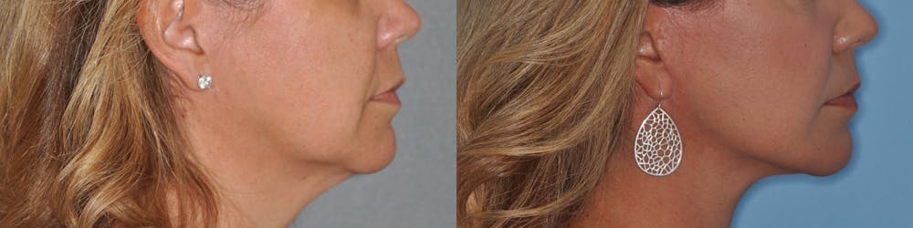 Facelift Before & After Gallery - Patient 31709460 - Image 2