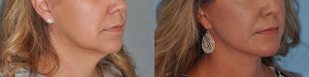 Facelift Before & After Gallery - Patient 31709460 - Image 3