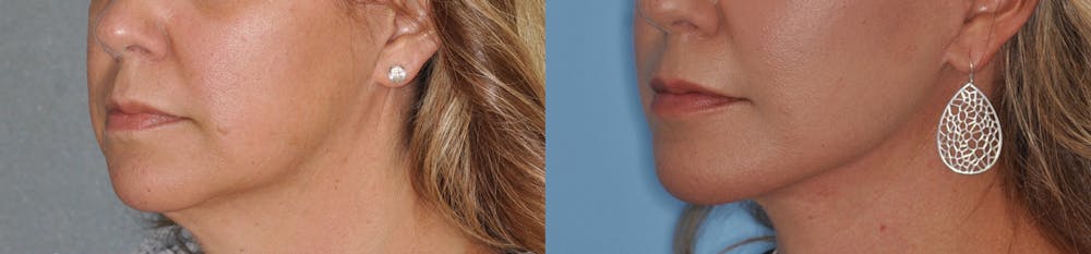 Facelift Before & After Gallery - Patient 31709460 - Image 4