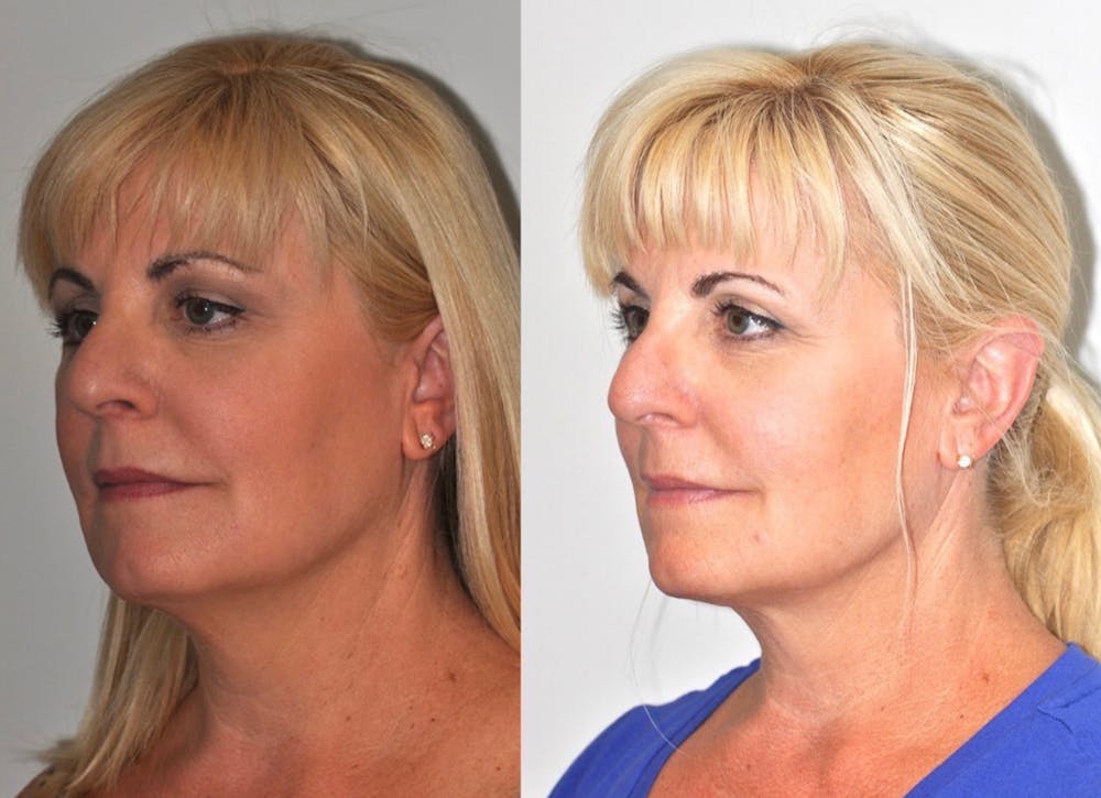 FaceTite & ThermiTight Before & After Gallery - Patient 31709214 - Image 1