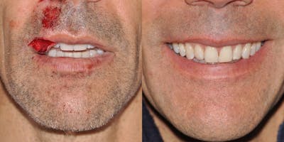 Facial Reconstruction Before & After Gallery - Patient 31709204 - Image 2