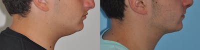 Neck Liposuction Before & After Gallery - Patient 31709173 - Image 1