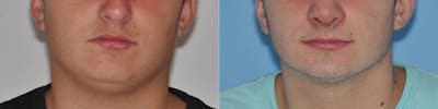 Neck Liposuction Before & After Gallery - Patient 31709173 - Image 2