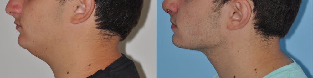Neck Liposuction Before & After Gallery - Patient 31709173 - Image 3
