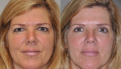 Blepharoplasty Before & After Gallery - Patient 31709261 - Image 1
