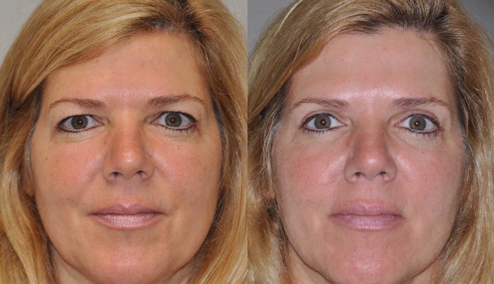 Blepharoplasty Before & After Gallery - Patient 31709261 - Image 1