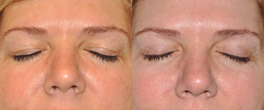 Blepharoplasty Before & After Gallery - Patient 31709261 - Image 2