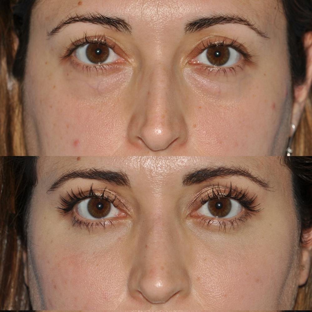 Blepharoplasty Before & After Gallery - Patient 58470292 - Image 2