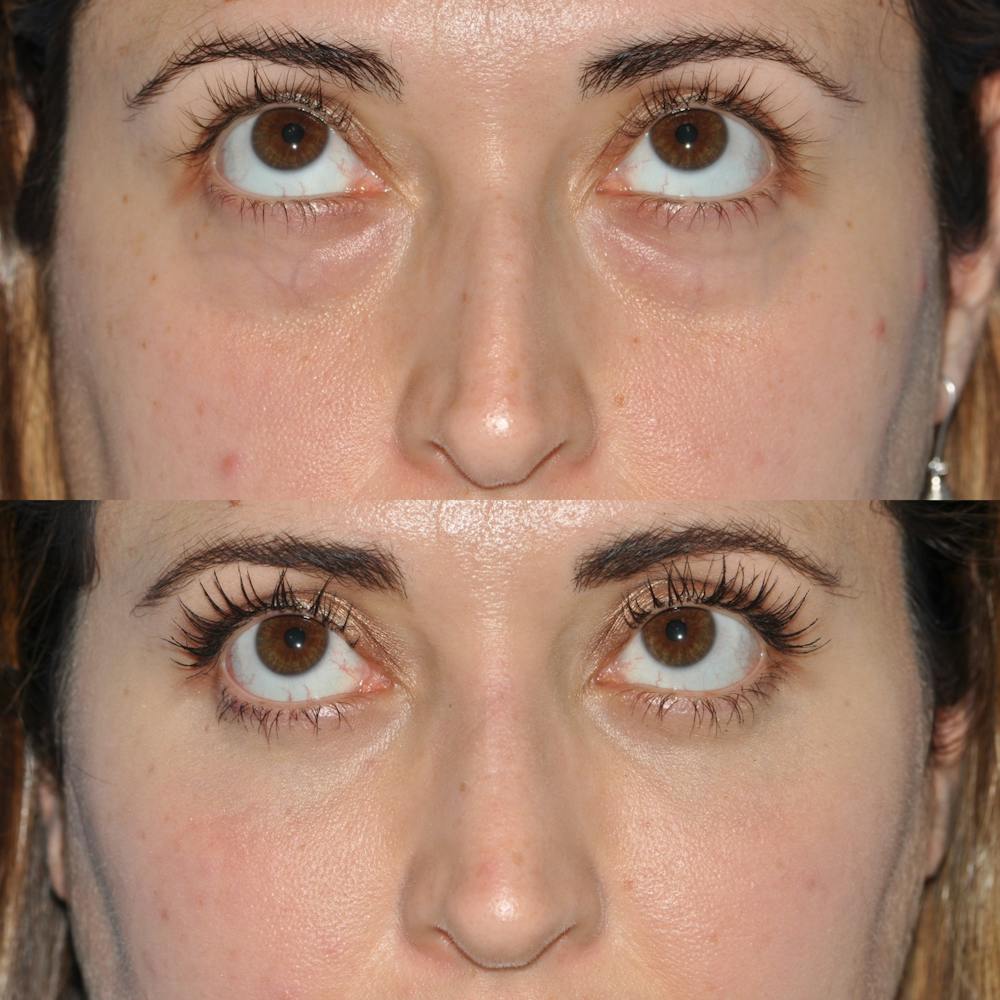 Blepharoplasty Before & After Gallery - Patient 58470292 - Image 3