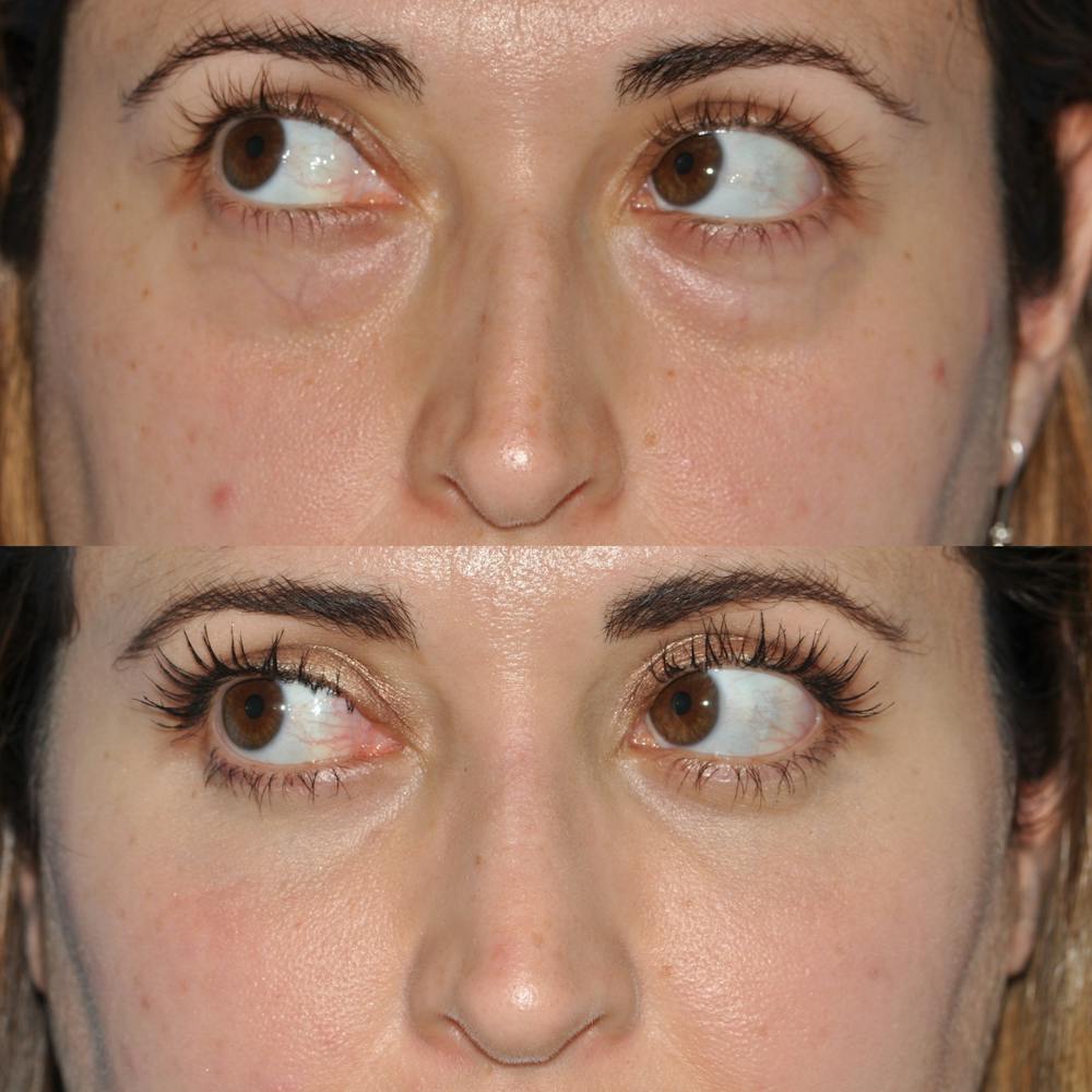 Blepharoplasty Before & After Gallery - Patient 58470292 - Image 4