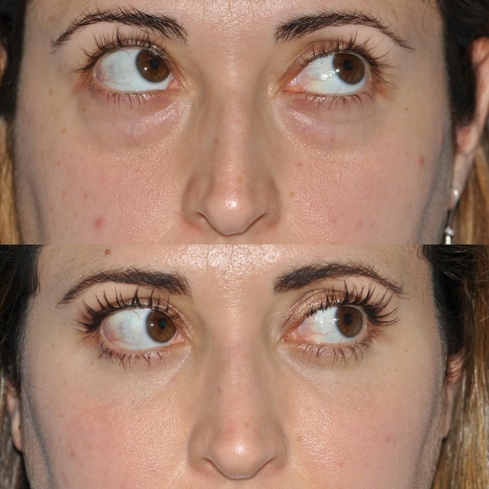 Blepharoplasty Before & After Gallery - Patient 58470292 - Image 5