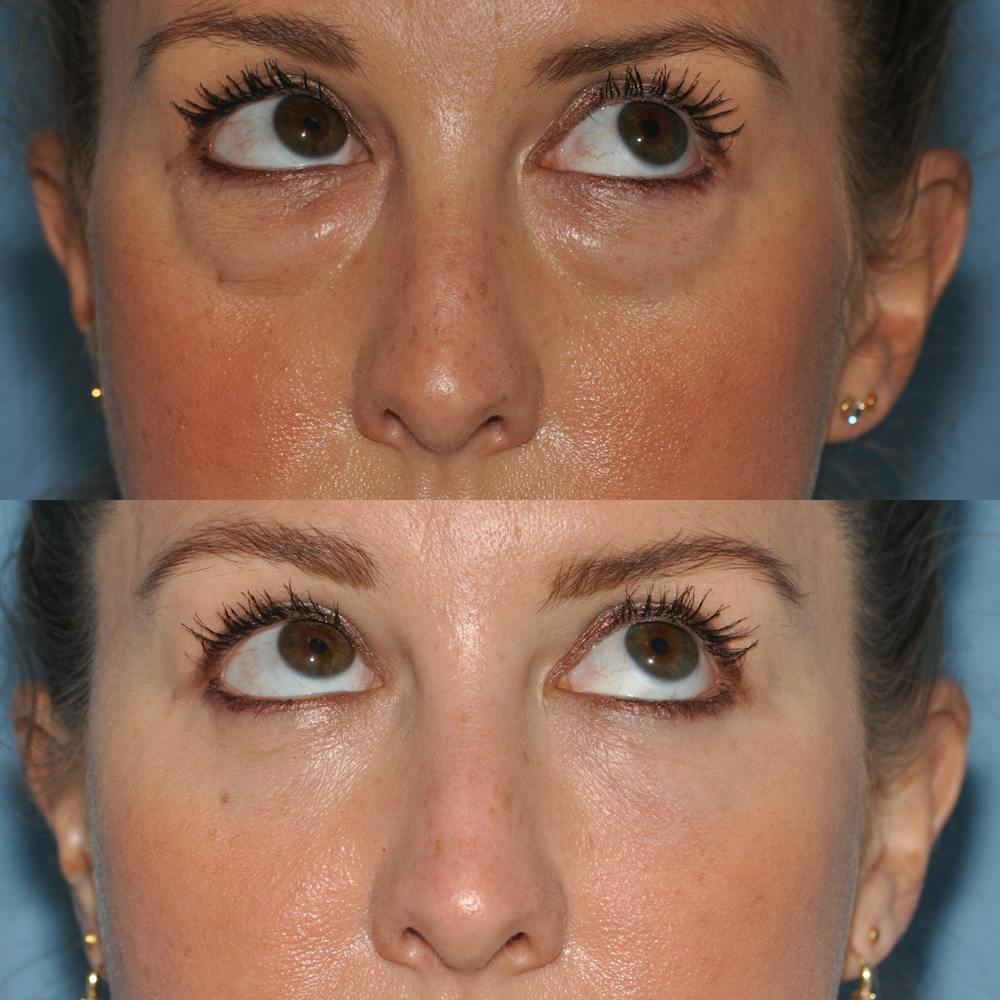 Blepharoplasty Before & After Gallery - Patient 58470293 - Image 2