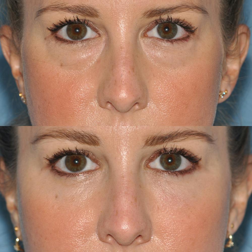 Blepharoplasty Before & After Gallery - Patient 58470293 - Image 3