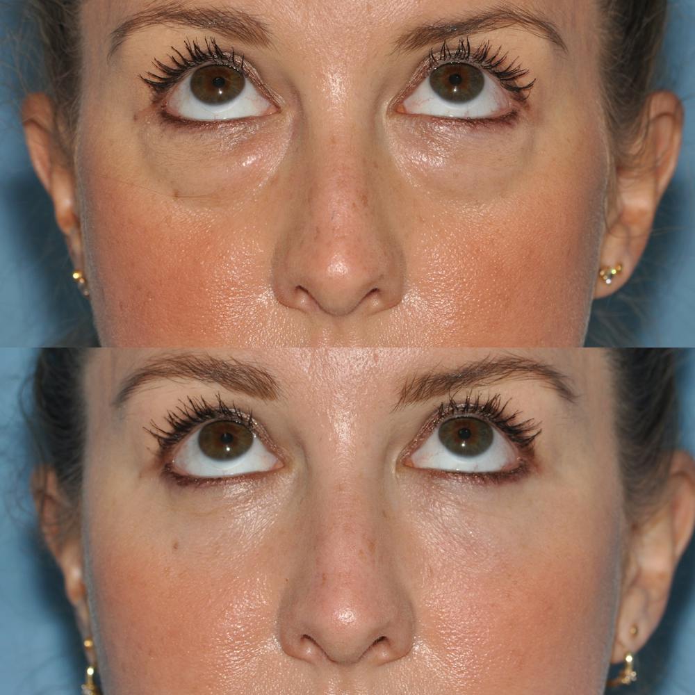 Blepharoplasty Before & After Gallery - Patient 58470293 - Image 5